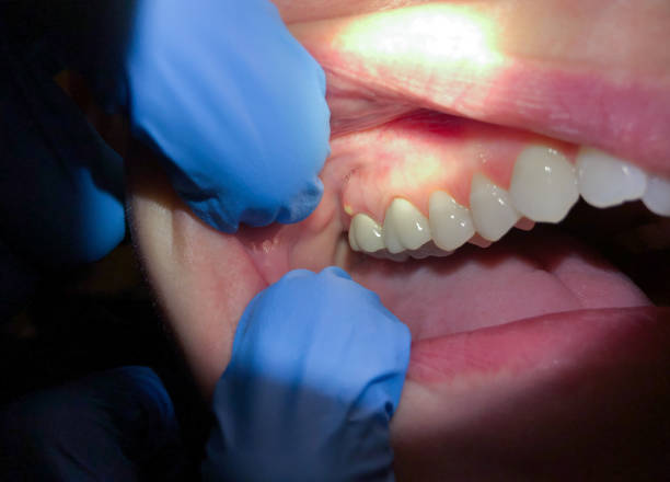 Best Emergency Cosmetic Dentistry (e.g., broken veneers) in Fort Worth, TX